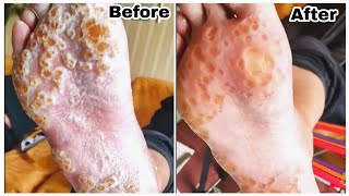 Callus Remove satisfyingsatisfyingvideo shorts diy callusremovalcallusremover footcarecr7 [upl. by Dibbrun123]