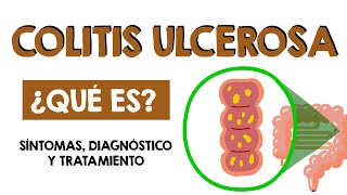 COLITIS ULCEROSA en MENOS de 5 MINUTOS [upl. by Drofiar]