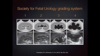 Grading Hydronephrosis on Bedside Ultrasound [upl. by Aihsemot]