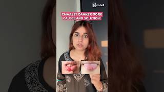 How to cure canker sore or chaale  Nutshell shorts 158  shorts [upl. by Friend574]