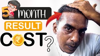 Best Hair Growth Result of HAIR Transplant in INDIA 2024  Hair transplant Cost  Sonu Kumar Mishra [upl. by Dominique]