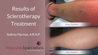 What Are the Results of Sclerotherapy Treatment [upl. by Verlie]