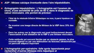 GASTROENTEROLOGIE LITHIASE DE LA VOIE BILIAIRE PRINCIPALE 2016 [upl. by Schurman]