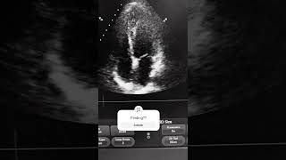 echocardiography spotfinding echofinding [upl. by Meadow]