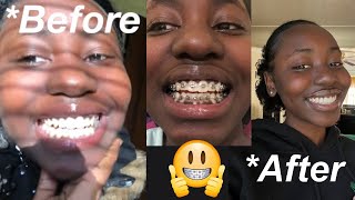 My Braces Journey From Start To Finish [upl. by Leavelle785]