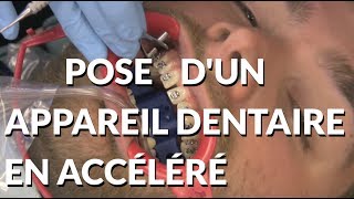 Pose dun appareil en accéléré  Appareildentaireinfo [upl. by Brout57]