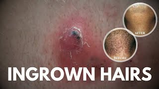 What are Ingrown hairs How to get rid of ingrown hairs [upl. by Veator]