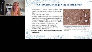 CK18 as a Biomarker in NASH Clinical Trials [upl. by Rachael925]