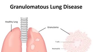 Granulomatous diseases of Lung Introduction [upl. by Pirozzo149]