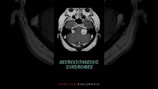 Neurocutaneous syndromes  Radiology tutorials  Radiology Everywhere [upl. by Yerffe]