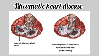 Community medicine  Rheumatic heart disease communitymedicine cardiovascularsystem [upl. by Eentroc]