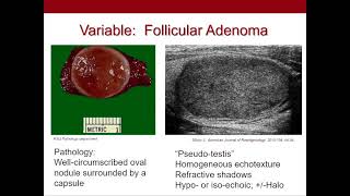 Thyroid Nodules What We Know and What We Dont Ultrasound Video [upl. by Schafer355]