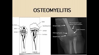 Acute Osteomyelitis [upl. by Haimorej20]