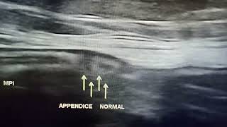 Échographie pelvienne Appendice normal [upl. by Recor]