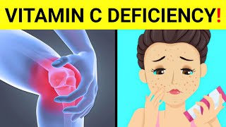 15 Signs And Symptoms Of Vitamin C Deficiency   Vitamin C Deficiency [upl. by Enyluqcaj]