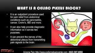 Celiac Plexus Block for Abdominal Pain Explained 602 5076550 [upl. by Seluj]