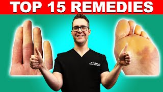 Raynauds Syndrome Top 15 Remedies Symptoms amp Best Treatment [upl. by Anawak]