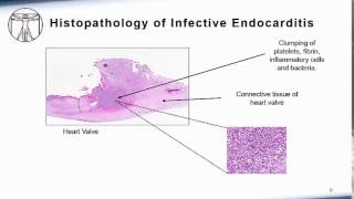 Endocarditis Pathophysiology [upl. by Shayla]