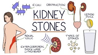 Understanding Kidney Stones [upl. by Herman529]