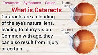 What is cataractsTreatmentSymptoms amp Causes [upl. by Rora]