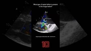 Echocardiography Question 12 [upl. by Llenaj]