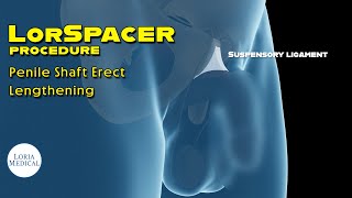 Suspensory Ligament Release procedure How its done [upl. by Ruel]