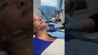 PDO Threads to tighten and lift neck  nonsurgical neck lift by Dr Pamela Kulback [upl. by Haikan]