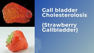 Gall bladder cholesterolosis Strawberry Gallbladder [upl. by Nogem774]