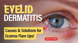 Eyelid Dermatitis Uncovered Causes and Solutions [upl. by Henleigh466]