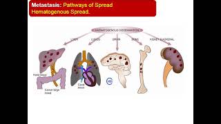 2  Neoplasia Characteristics of Tumors [upl. by Ainessej]