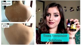 Tinea Versicolor SOLUTIONS TNBeauty94 [upl. by Nivrem]