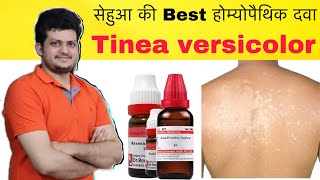 सेहुआ की Best Homeopathic Medicine  Tinea versicolor Remove Combination  How to Use [upl. by Meekahs]