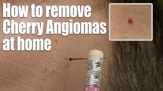 How to remove Red Skin Dots at home Quick amp Easy Cherry Angioma treatment [upl. by Ayetal]