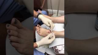 Aspiration and Drainage Cyst from Foot [upl. by Aniluap]