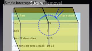 Suture Removal A Video for Patients [upl. by Caterina]