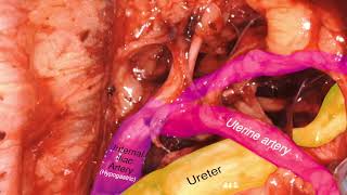 Laparoscopic Review of Internal Iliac Artery [upl. by Ened844]