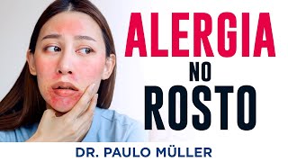 Alergia no Rosto Dermatite da Face – Dr Paulo Müller Dermatologista [upl. by Eamanna]