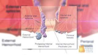 What Are Hemorrhoids  Doctor Robert Evans [upl. by Abekam141]