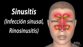 Sinusitis Animación Alila Medical Media Español [upl. by Aiderfla73]