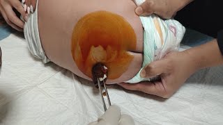 Lumbar puncture LP procedure  Spinal fluid tap [upl. by Sheffie]