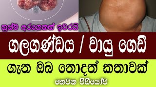 ගලගණ්ඩය හෙවත් වායු ගෙඩි  Goiters  තයිරොයිඩ් ග්රන්ථියේ රෝග  වීඩියෝ අංක 03  ගලගණ්ඩය Galaganda [upl. by Fessuoy]