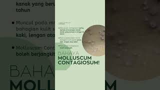 Bahaya Molluscum Contagiosum di kalangan kanakkanak😱 molluscumcontagiousum drlynaestetik [upl. by Nirred]