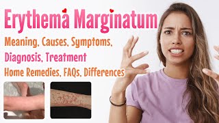 Erythema marginatum overview meaning signs and symptoms diagnosis treatment home remedies FAQs [upl. by Oderfodog]