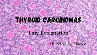 Thyroid Carcinomas  Introduction  emotionalmedico [upl. by Eidoow]