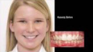 Fry Orthodontic Specialists GAC Innovation C Braces [upl. by Greene]