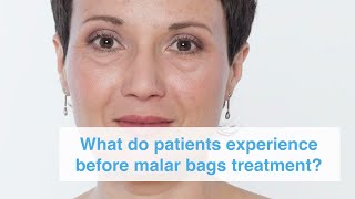 What do patients experience before malar bags treatment [upl. by Namas]