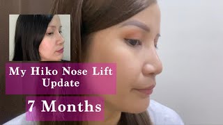 My Hiko Nose Lift Update 7 Months [upl. by Ayikur975]