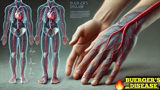 Buergers Disease Thromboangiitis Obliterans Easy Explanation [upl. by Lauder]