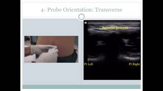 Ultrasound Guided Lumbar Puncture [upl. by Erastus]