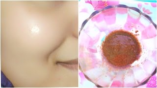 How To Remove Acne Pimples Overnight 100 Works 5 Home Remedies  Acne Scar Treatment [upl. by Gelb]